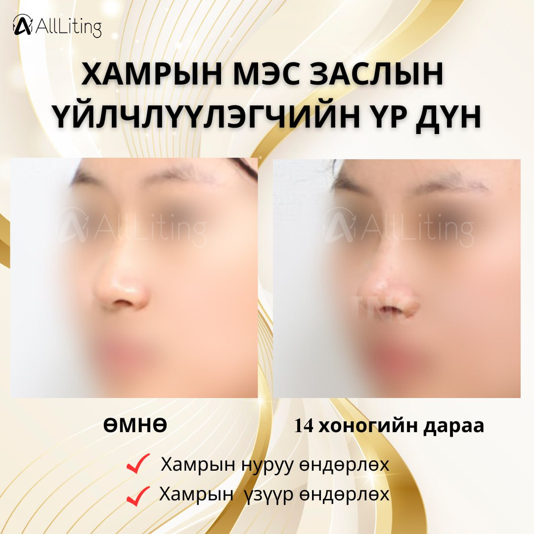 #БОДИТ_ҮР_ДҮН #ХАМРЫН_МЭС_ЗАСАЛХийлгэсэн ажилбар 📷Хамрын нуруу өндөрлөх 📷Хамрын үзүүр өндөрлөх ------ 📷📷 ҮЗЛЭГ/ЗӨВЛӨГӨӨ үнэгүй хийж зөвхөн таньд тохирсон мэс заслын төлөвлөгөөг гаргана. 📷монгол ажилтан: 010-4931-4451 📷