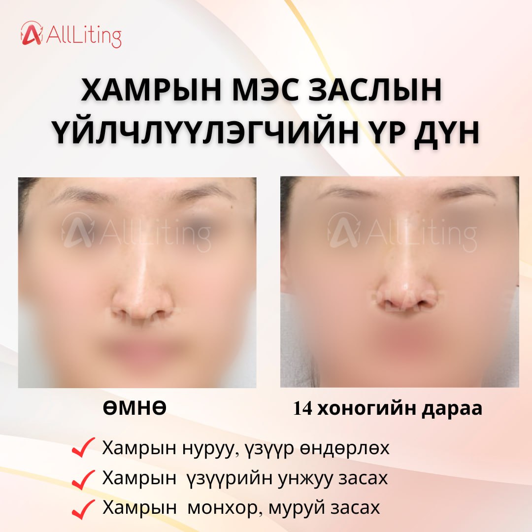 #БОДИТ_ҮР_ДҮН #ХАМРЫН_МЭС_ЗАСАЛ
Хийлгэсэн ажилбар
✅Хамрын нуруу, үзүүр өндөрлөх
✅Хамрын үзүүрийн унжуу засах
✅Хамрын монхор, муруй засах
---------------------
📍📍 ҮЗЛЭГ/ЗӨВЛӨГӨӨ үнэгүй хийж зөвхөн таньд тохирсон мэс заслын төлөвлөгөөг гаргана.
☎️монгол ажилтан: 010-4931-4451