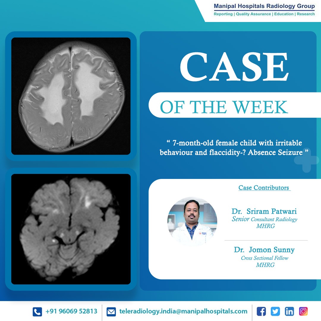 ManipalMhrg's tweet photo. Presenting our #CaseOfTheWeek - A 7-month-old female child with irritable behaviour and flaccidity-? Absence Seizure

Know more: https://t.co/TUlvslrW7R

#radiologyy #teleradiology #MHRG https://t.co/nqYLu4xvUC