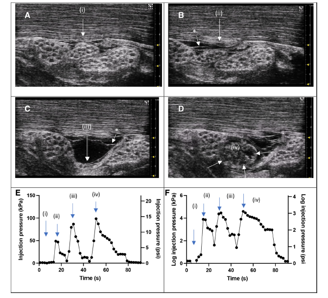 Our paper out in: rapm.bmj.com/content/48/10 Needle tip position was not discernible using pressure monitoring. The circumneurium and subcircumneural injection compartment were observed but not intrafascicular injection. @ESRA_Society @RegionalAnaesUK @RAPMOnline