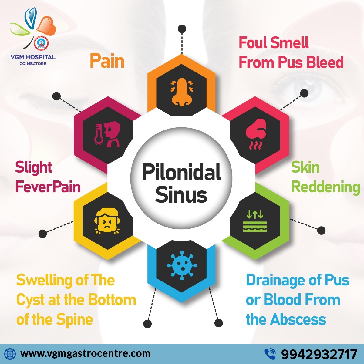 Pilonidal sinus commonly affects the area at the base of the spine. Timely medical intervention is crucial to prevent complications and promote healing. 

#VGMHospital #VGMGastroCentre #pilonidalsinus #pilonidalcyst #painmanagement #surgicaltreatment #skininfection