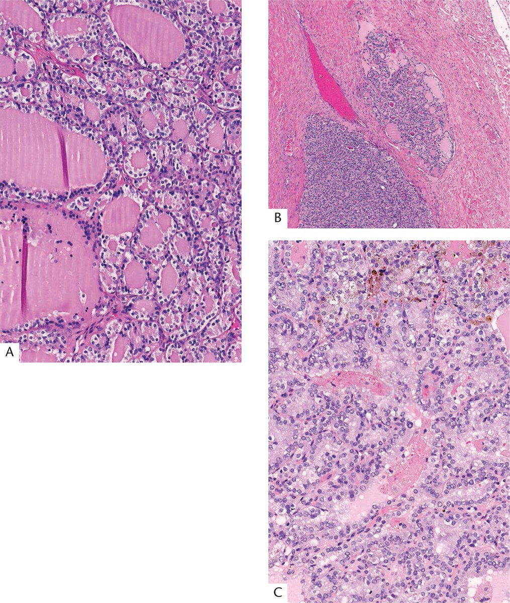 While we're looking at thyroid tissue here, we are still indeed discussing the ovary fascicle - this is struma ovarii (A), a type of monodermal teratoma! Thyroid-type neoplasms can occur in these, including follicular (B,C) or papillary carcinoma. #GynPath