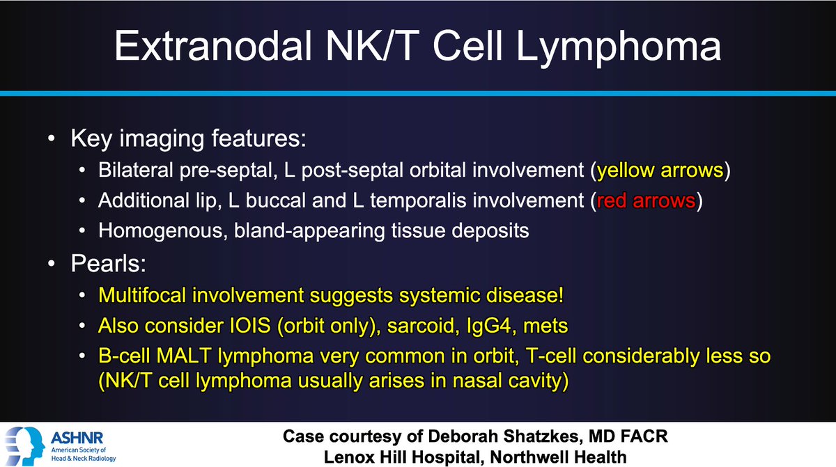 #ASHNRCOTW #225 ANSWER: Extranodal NK/T Cell Lymphoma! Thx Dr. <a href="/DShatzkes/">Deborah Shatzkes</a> #ASHNR23 

<a href="/AshokSrini15/">Ashok Srinivasan</a> <a href="/callyrobs/">Caroline Robson, MBChB</a> <a href="/CDP_Rad/">C Douglas Phillips 🇺🇸</a> <a href="/rhwiggins/">Richard Wiggins</a> <a href="/nakoontz/">Nicholas Koontz</a> <a href="/cmtomblinson/">Courtney Tomblinson, MD</a> <a href="/WmOBrienDO/">William T. O'Brien, DO 🧠🩻</a> <a href="/ESHNRSociety/">ESHNR</a> <a href="/tabby_kennedy/">Tabby A. Kennedy, MD</a> <a href="/amyfjuliano/">Amy Juliano</a> <a href="/AnnJayMD1/">Ann Jay MD</a> <a href="/CMGlastonbury/">Christine M Glastonbury, MD</a> <a href="/PhilipRChapman1/">Philip R. Chapman, MD</a> <a href="/nancyfstanford/">Nancy Fischbein</a> <a href="/phudge54/">Pat Rhyner</a>