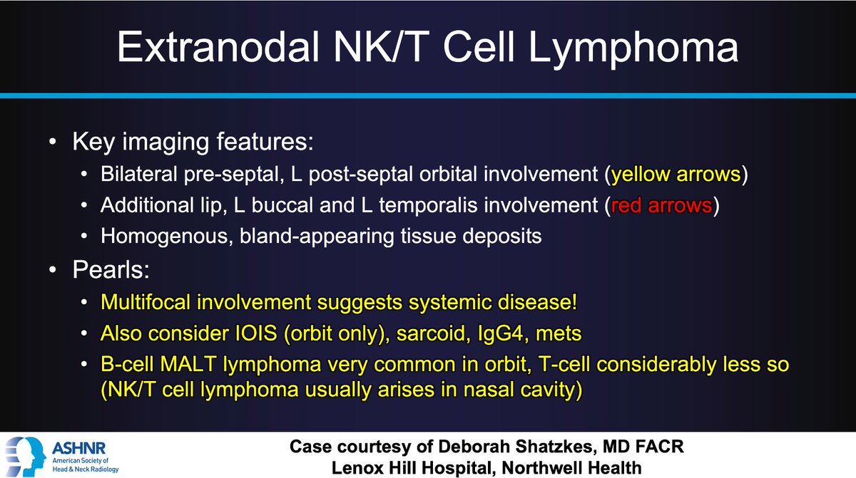 #ASHNRCOTW #225 ANSWER: Extranodal NK/T Cell Lymphoma! Thx Dr. @DShatzkes #ASHNR23 @AshokSrini15 @callyrobs @CDP_Rad @rhwiggins @nakoontz @cmtomblinson @WmOBrienDO @ESHNRSociety @tabby_kennedy @amyfjuliano @AnnJayMD1 @CMGlastonbury @PhilipRChapman1 @nancyfstanford @phudge54