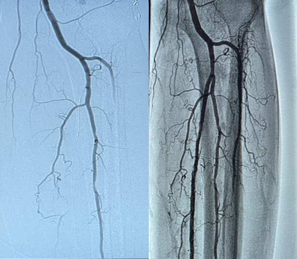 ShockwaveIVL's tweet photo. Dr. Manolo Rubio Garcia, interventional cardiologist at @sharphealthcare, treated an 86 yo with an ambiguous CTO &amp; IVUS confirmed significant disease. He gained pedal access &amp; used 3.5mm #ShockwaveS4 to restore flow.

US Rx only. ISI https://t.co/sZ0NdzXNcV #ShockwaveIVL https://t.co/IM9gM1AHPw