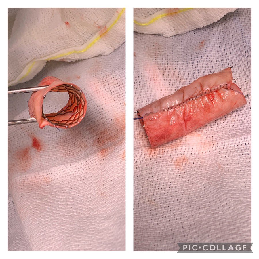 Nice case below, I incorporate the bovine about a venous stent to minimize any compression in the future and to keep anastomoses widely patent.  Have 4 with good results at 6 months.