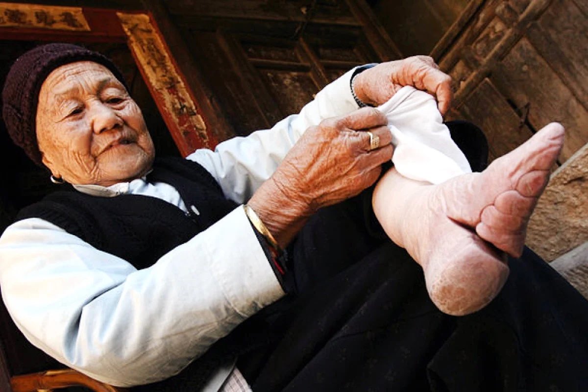 ConFactor's tweet image. For centuries, the feet of Chinese women were tightly bound from a young age as part of a traditional custom, causing the breaking and bending of the bones of the toe. This resulted in extremely disfigured feet that resembled the hooves of animals.