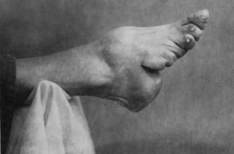 ConFactor's tweet image. For centuries, the feet of Chinese women were tightly bound from a young age as part of a traditional custom, causing the breaking and bending of the bones of the toe. This resulted in extremely disfigured feet that resembled the hooves of animals.