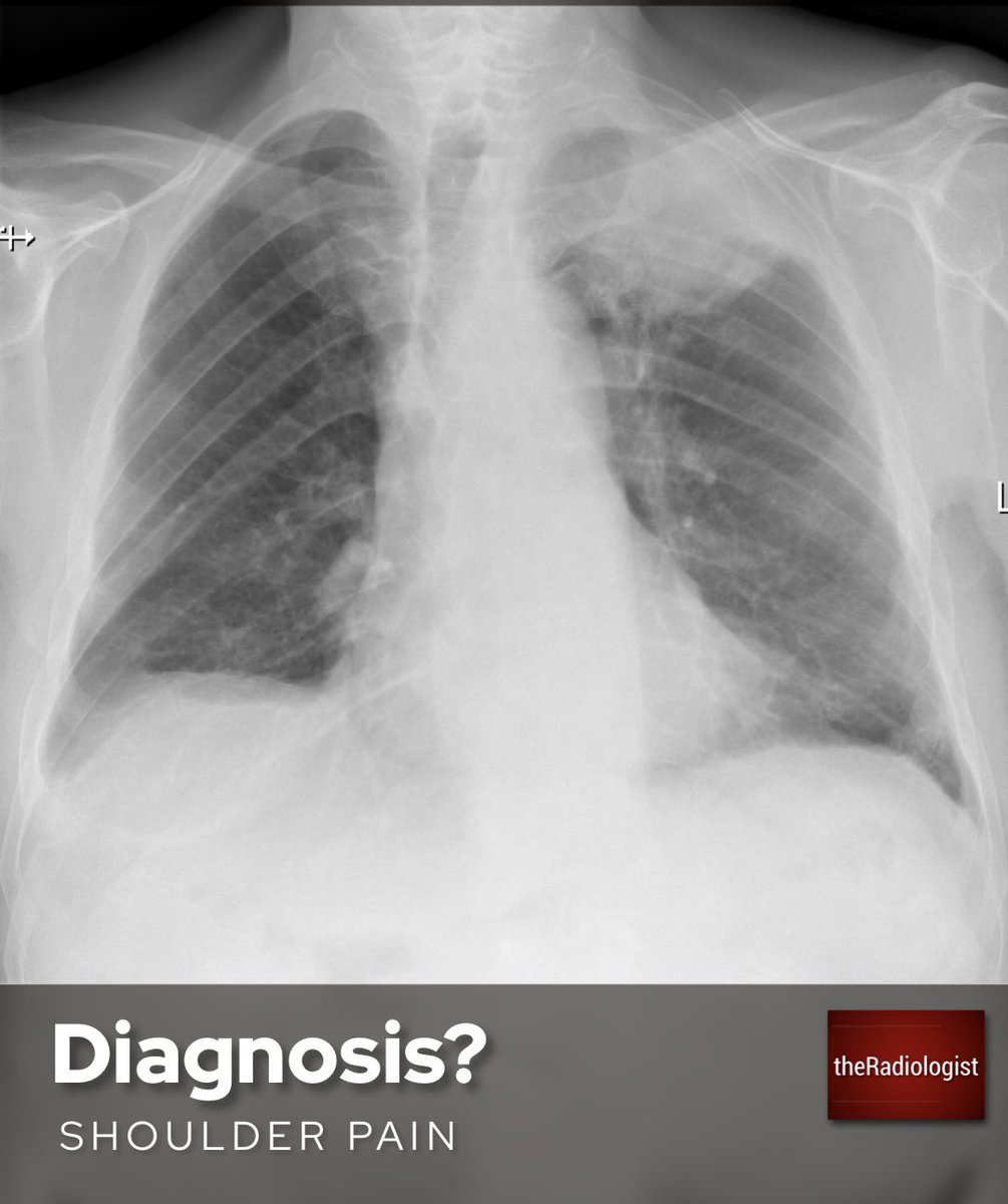 radiologistpage's tweet photo. Male with shoulder pain. What is the diagnosis? https://t.co/brxLTvyr0f