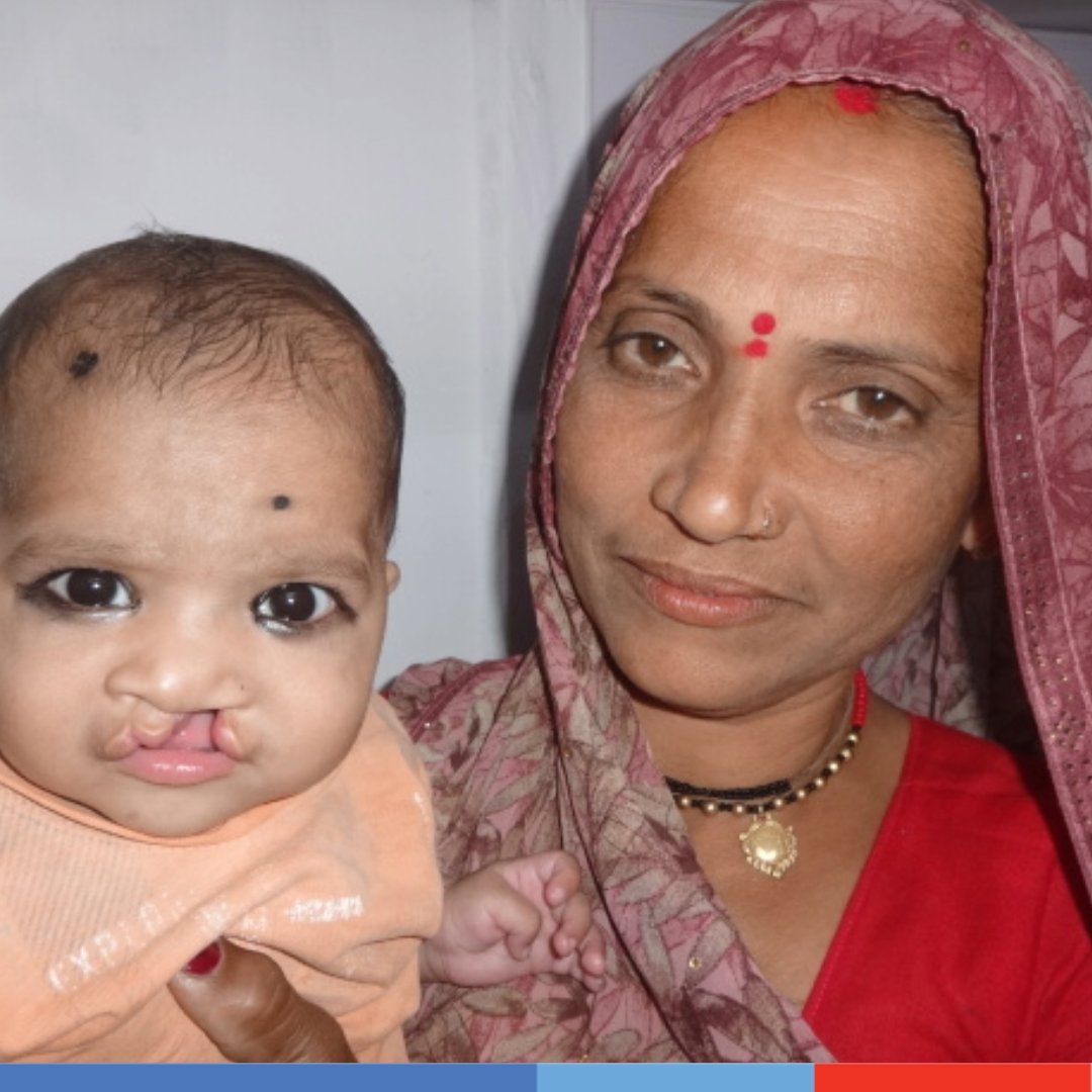 SmileTrainIndia's tweet photo. Meet Naina! 

Naina's parents struggled to find a solution for her #cleft, and finally, they found our partner, New Leelamani Hospital in #Kanpur.

We wish Naina a happy and fulfilling life😍

#ThursdayStories #Safesurgeries #successstories https://t.co/VFEJqdzivb