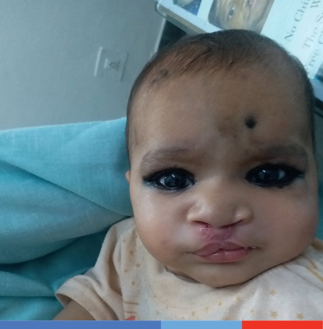 SmileTrainIndia's tweet photo. Meet Naina! 

Naina's parents struggled to find a solution for her #cleft, and finally, they found our partner, New Leelamani Hospital in #Kanpur.

We wish Naina a happy and fulfilling life😍

#ThursdayStories #Safesurgeries #successstories https://t.co/VFEJqdzivb