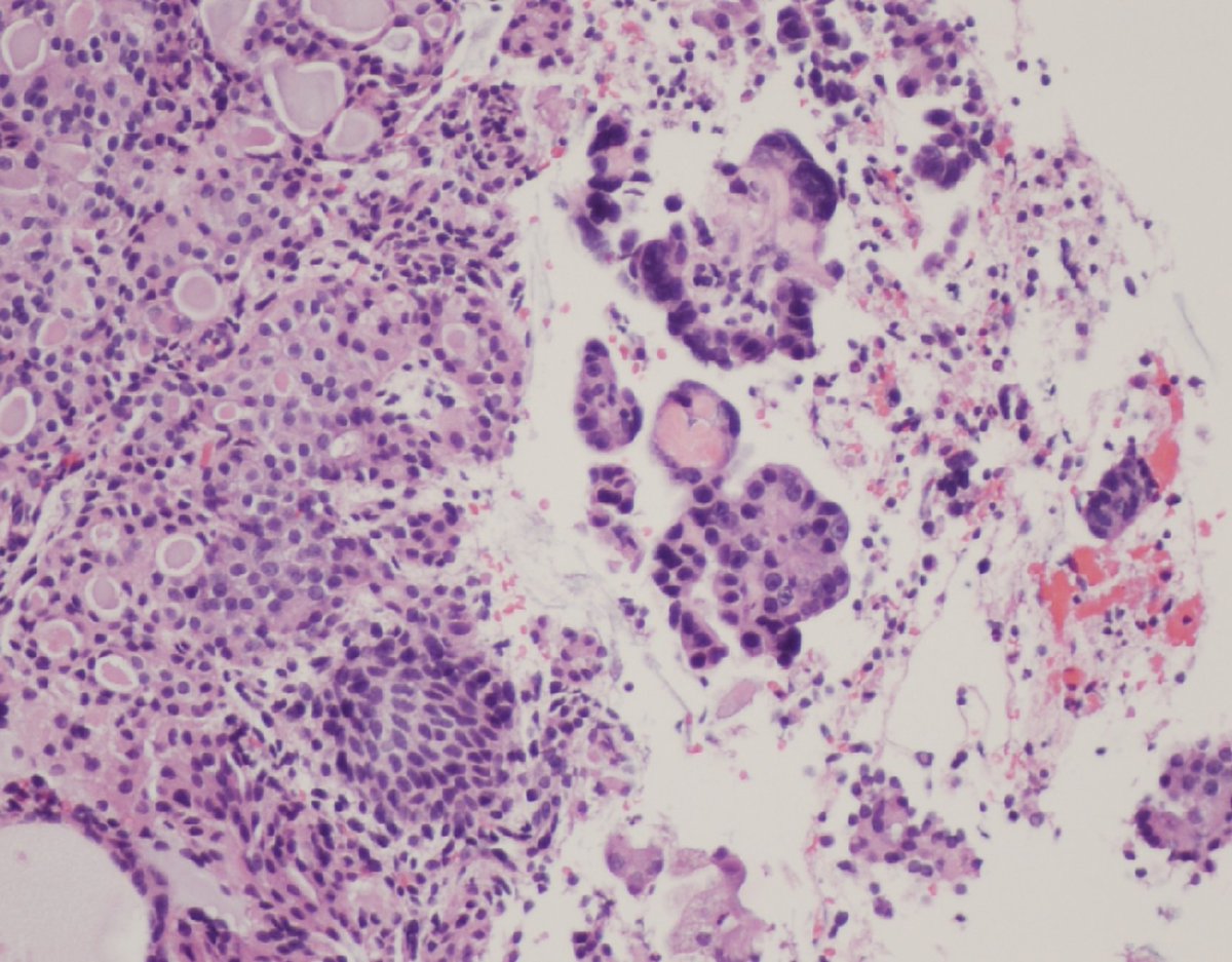 Not great pictures but still worth sharing with #Pathtwitter 65 Y with AUB. EMB showed side by side serous carcinoma and microglandular hyperplasia-like endometrioid adenocarcinoma! IHCs are p53 and Ki67 #Gynpath