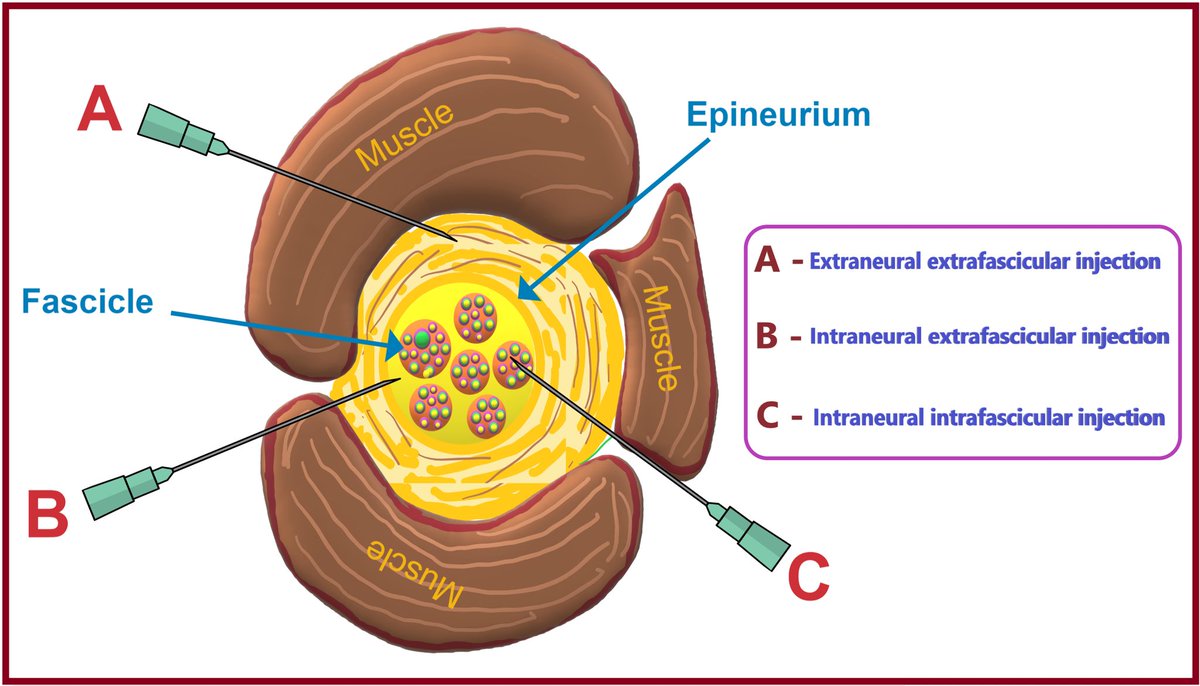 Knowing It Before Blocking It,” the ABCD of the Peripheral Nerves: Nerve Injury Types, Mechanisms, and Pathogenesis Excellent article ➡️➡️ cureus.com/articles/16677…