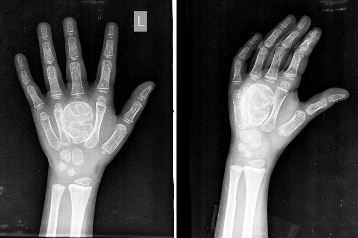 ASK_MSK's tweet photo. Bone tumor of the day #6

▶️Well defined expansile lesion with osteoid matrix
▶️Involving almost entire third metacarpal

➡️Biopsy proven osteosarcoma https://t.co/IXOfvXgHH4