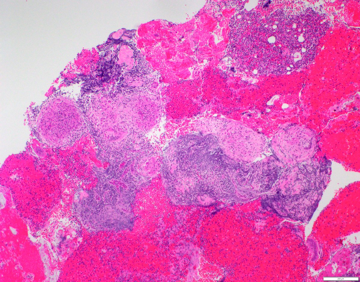 UpstateCytology's tweet photo. Thank you for participating! These are non-necrotizing granulomas. Sarcoidosis and infectious etiologies are on the differential, but don't forget the tumors that can show granulomas (eg. seminoma &amp; Hodgkin lymphoma). Cell block &amp; other examples are attached. #cytology https://t.co/5YliPfx96i
