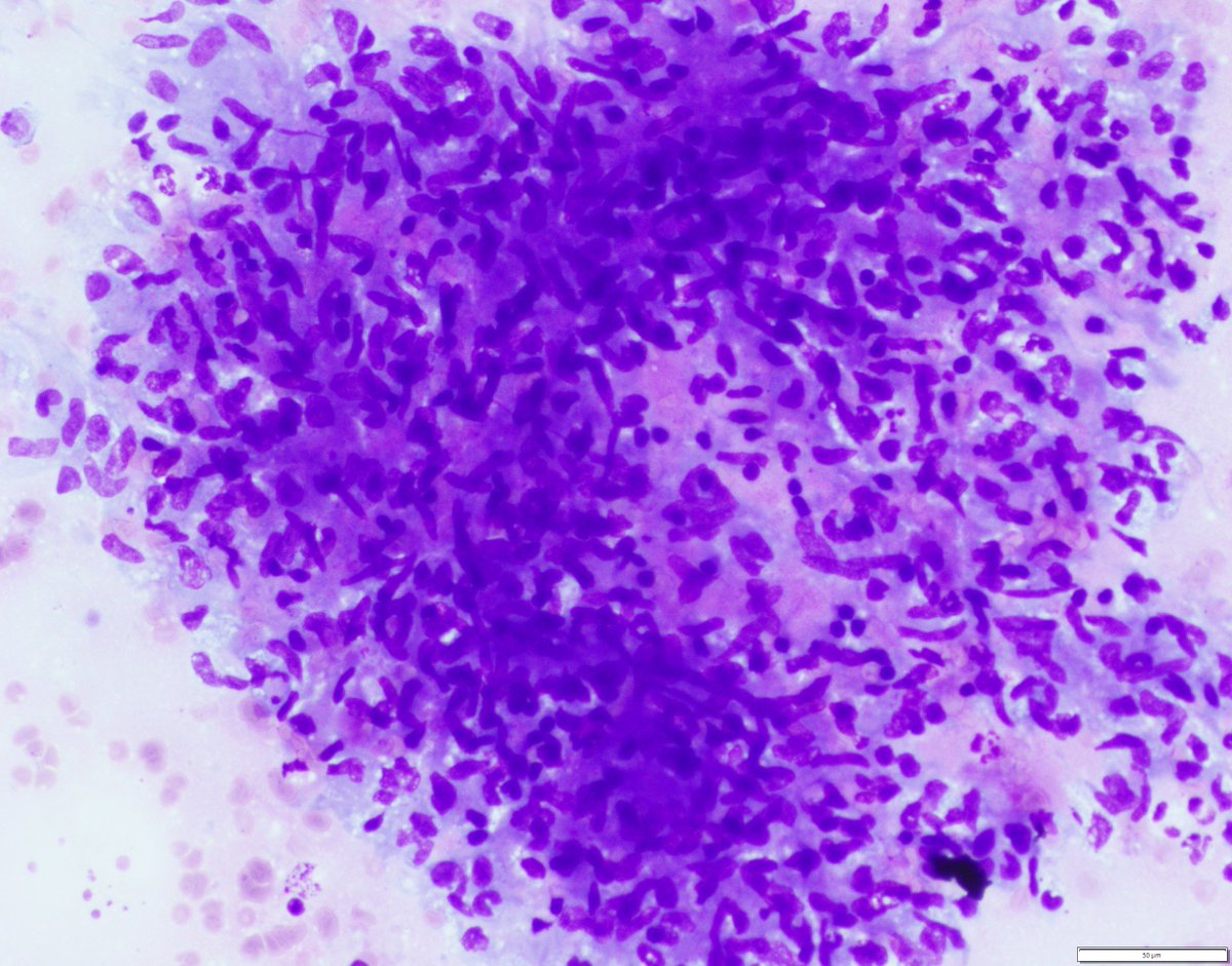 UpstateCytology's tweet photo. Thank you for participating! These are non-necrotizing granulomas. Sarcoidosis and infectious etiologies are on the differential, but don't forget the tumors that can show granulomas (eg. seminoma &amp; Hodgkin lymphoma). Cell block &amp; other examples are attached. #cytology https://t.co/5YliPfx96i