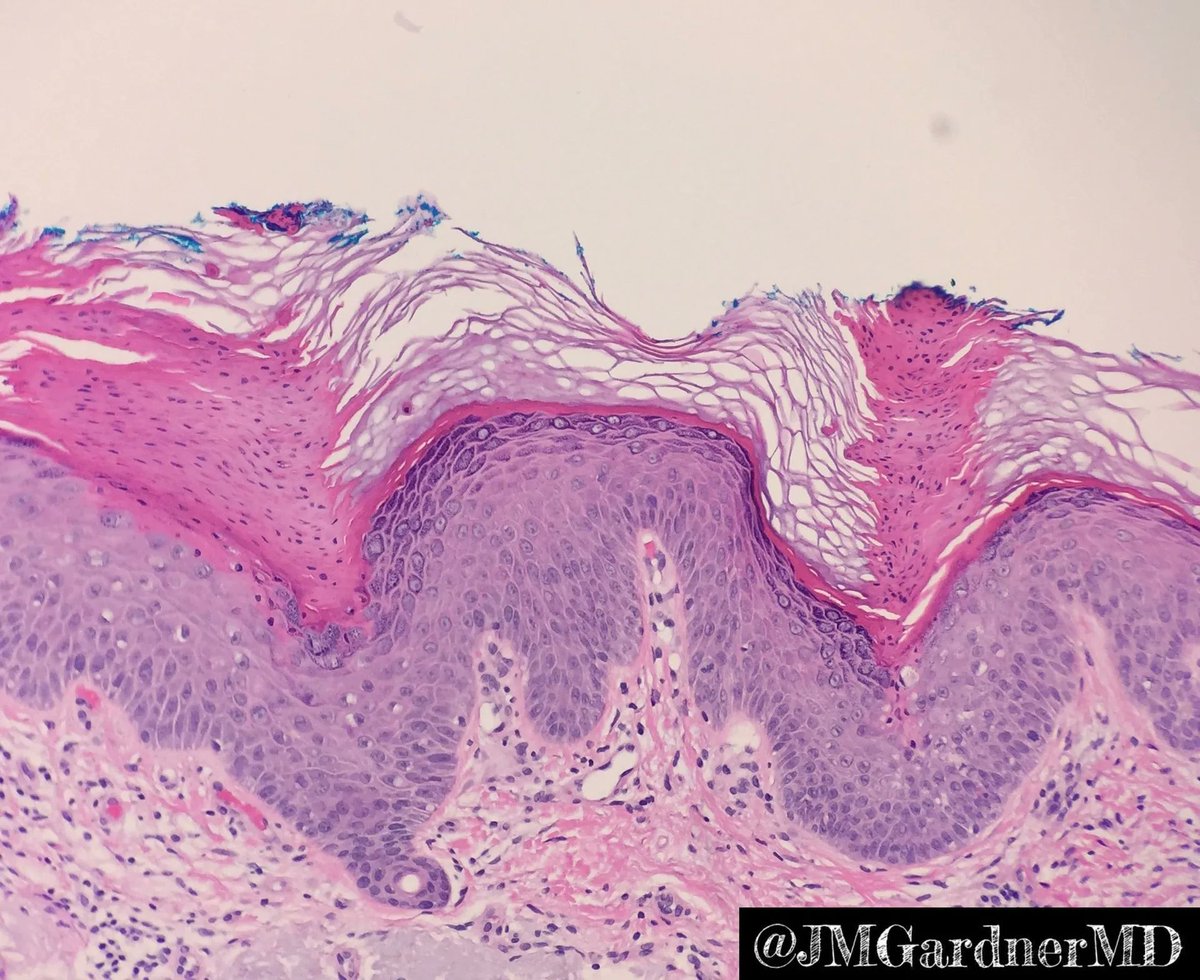Classic! What is this? Answer & labeled pics with arrows: kikoxp.com/posts/10624. Another amazing example: kikoxp.com/posts/10640. Video: kikoxp.com/posts/4376 #pathology #pathologists #pathTwitter #dermpath #dermatology #dermatologia #dermtwitter