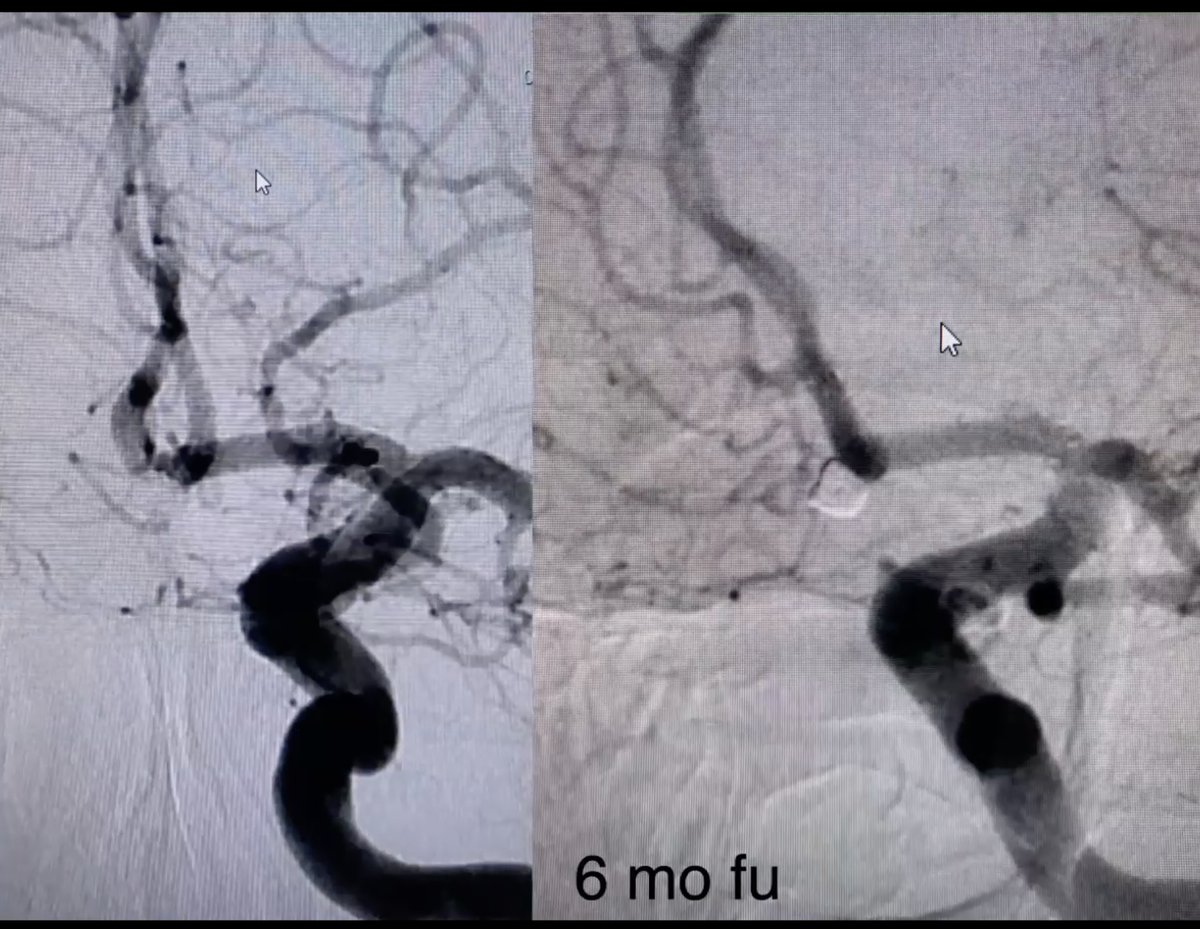 Huge thanks to <a href="/robertereplogle/">Robert Replogle MD</a> and <a href="/JCappuzzoMD/">Justin</a> for sharing their invaluable insights and cases using PC400 during the "Efficiency and Versatility - Advancements with a .020" Coil" webinar. It was a pleasure to learn from their experiences!