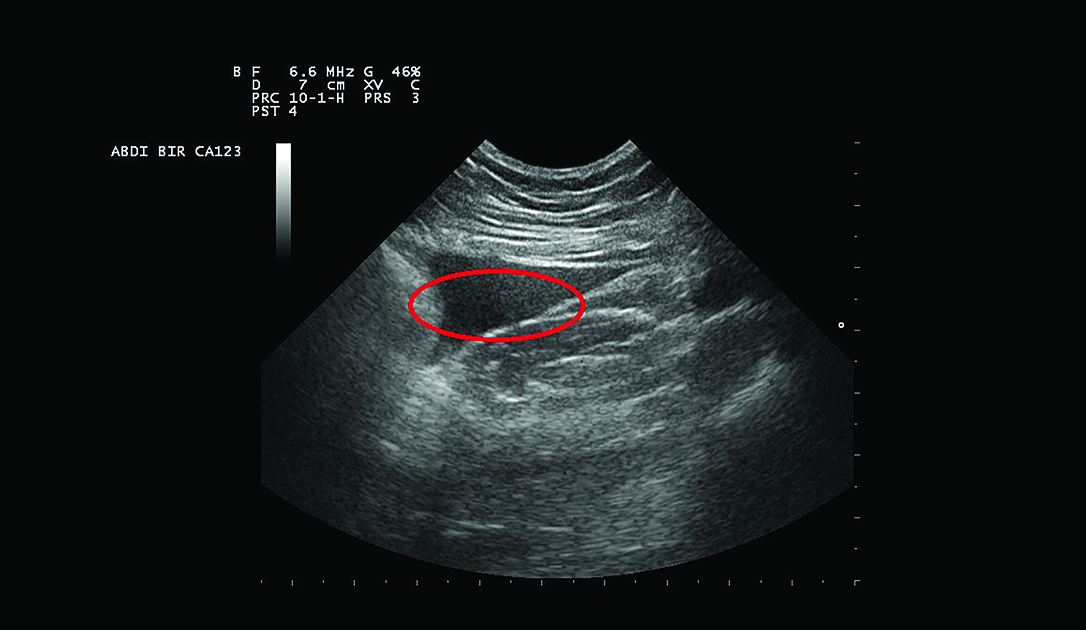 The use of POCUS in perioperative medicine continues to evolve rapidly and should be of particular interest in the field of trauma anesthesia. 📸: Abdominal fluid as shown in an ultrasound. The oval marks the fluid. Read Dr. Gearhead. ow.ly/GkJc50PyGoG @umiamimedicine