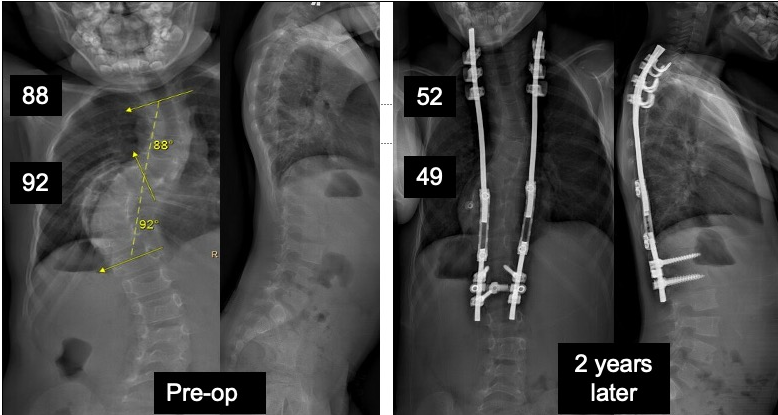 4 yo girl NF. Traditional growing rods chosen - MRI compatible to follow NF. At 2 years T1-S1 is 5cm longer and still growing. #Scoliosis #EarlyOnsetScoliosis #pediatrics #SpineSurgery @GuerinChildrens @CedarsSinai