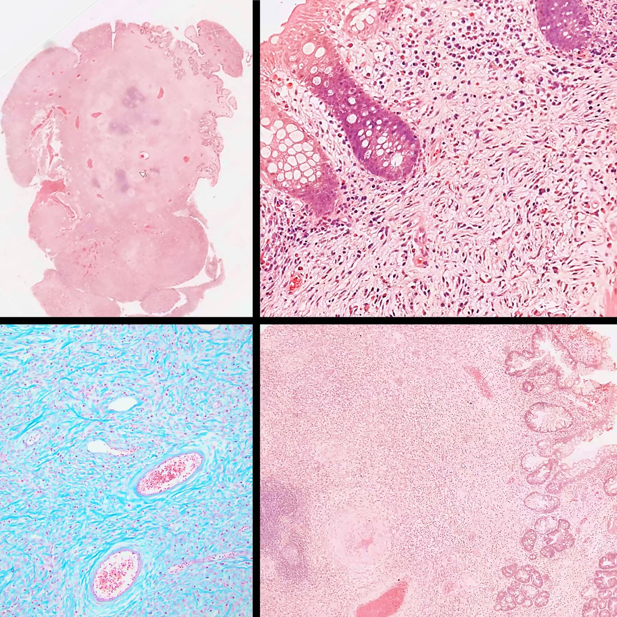 DrCycloPath's tweet photo. Rectal Mass
Diagnosis?
Hint in image description
Notes https://t.co/LuAe78sH03 edits appreciated
Signout @HassellLewis https://t.co/vA4XuKkHQa
#digitalpathology #dpatweet #GIPath #PathMatch24 #PathTwitter #BSTPath https://t.co/KzugUus3RH