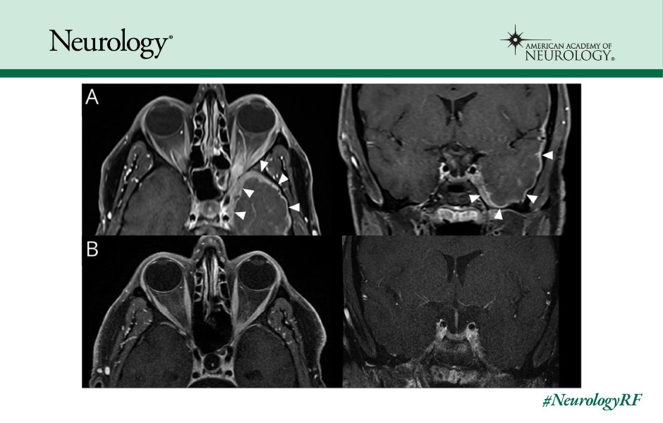 GreenJournal's tweet photo. Pearls &amp; Oy-sters: Idiopathic Orbital Inflammation and Tolosa-Hunt Syndrome With Intracranial Extension https://t.co/I3LcDX3NJa

#NeurologyRF #NeuroTwitter https://t.co/4xoyy6ByC4