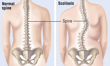 UniversalSurge1's tweet photo. #Neuromuscular #Monitoring and Wake-Up Test During #Scoliosis #Surgery 
Read more: https://t.co/BHWaQH0VQ8 
share your paper on: https://t.co/7f9IQq9XFt 
#ipjus 
#manuscript 
#reseach 
#Scoliosis #Surgery https://t.co/iiw4FGDXRa