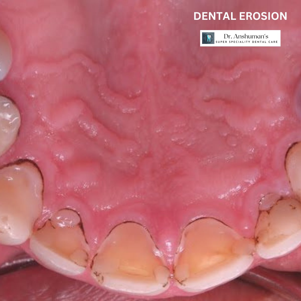 AnshumanSuper's tweet image. Dental erosion is the loss of the surface of your teeth due to acids you eat or drink, or acids coming up from your stomach.

Dr. Anshuman's Dental Clinic, Call: 7008414181

#teetherosion #teethproblem #teethcare #dentalcare #dentalhealth #Bhubaneswar #cuttack #Odisha #india
