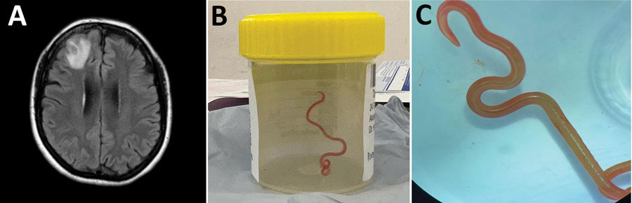 Prof Jan Slapeta (@janslapeta) on Twitter photo 8 cm long 🐍roundworm in brain of human 😵💫. Don’t mix brain 🧠 with worms 🪱. This accident is first known for 🪱 that usually circulates between Australian pythons 🐍 and 🐀.
Just published doi.org/10.3201/eid290… <a href="/Sydney_Vet/">Sydney Uni Vet Sci</a> <a href="/VetSciMelb/">FVS Melbourne</a> <a href="/AS_Para/">Aust Soc for Para</a> <a href="/ourANU/">ourANU</a> <a href="/Sydney_ID/">Sydney ID</a> 8 cm long 🐍roundworm in brain of human 😵💫. Don’t mix brain 🧠 with worms 🪱. This accident is first known for 🪱 that usually circulates between Australian pythons 🐍 and 🐀.
Just published doi.org/10.3201/eid290… <a href="/Sydney_Vet/">Sydney Uni Vet Sci</a> <a href="/VetSciMelb/">FVS Melbourne</a> <a href="/AS_Para/">Aust Soc for Para</a> <a href="/ourANU/">ourANU</a> <a href="/Sydney_ID/">Sydney ID</a>