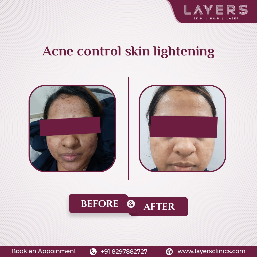 layersclinic's tweet image. Reveal Your Radiance Experience the Power of Acne Control and Skin Lightening at Layers Clinic - Witness the Before and After Transformation
Book an appointment: 8297882727
#acnecontrol #layersclinics #skinlightening #beforeandafter #acneremoval #acnetreatment #scarremoval