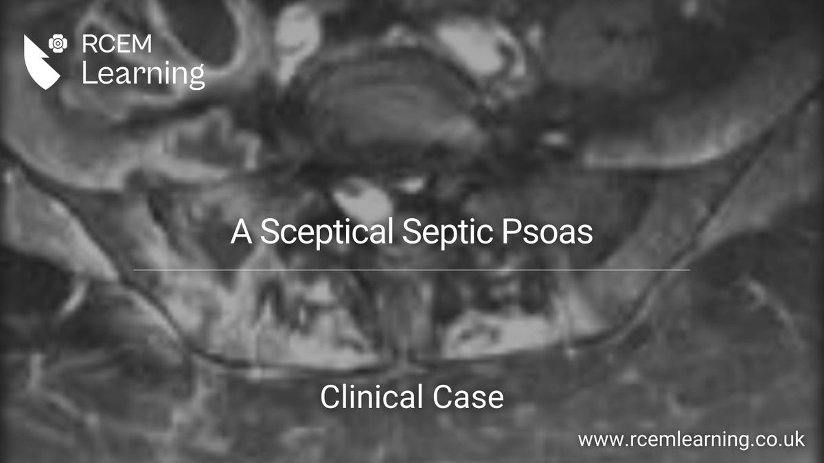 UPDATE: A 92-year-old lady was found on the floor by relatives. She was reportedly relatively fit and well, apart from a history of diverticulitis and atrial fibrillation. Read our #ClinicalCase here: rcemlearning.co.uk/modules/a-scep…