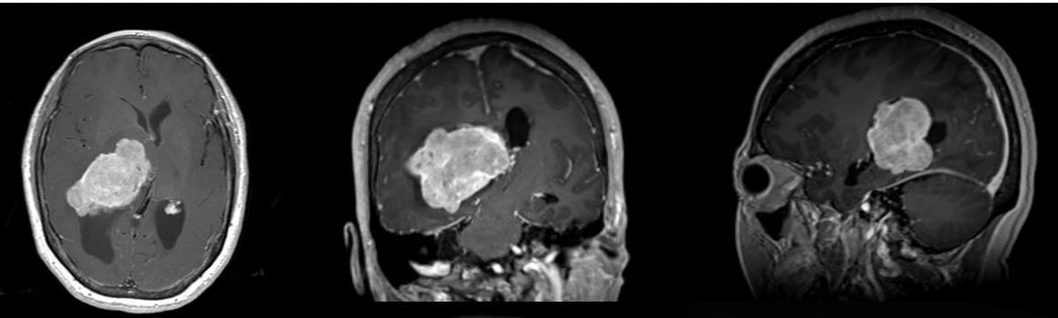 AshishHShah4's tweet photo. #Neurotwitter what is your differential diagnosis and approach for this tumor?
60 yo F with history of falls, left sided weakness and hemianopsia. No cancer history. @jacquesmorcosmd @michaelivanmd @UMneurosurgery @SamEmersonMDPhD @iahncajigas https://t.co/RVYQtWSLL1
