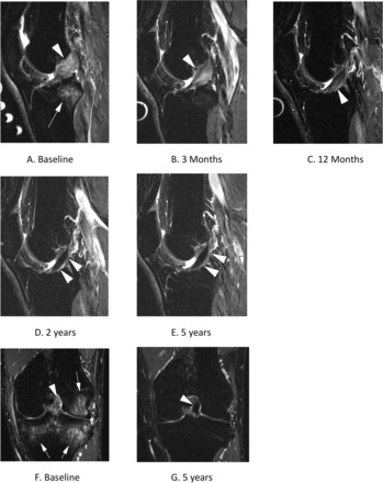 🚀 CURACIÓN DE LIGAMENTO CRUZADO ANTERIOR SIN CIRUGÍA

🔬 Más evidencias sobre la viabilidad de este fenómeno que podría suceder en al menos 1/3 de los casos. Vamos con el novedoso ensayo KANON

Dentro hilo. 🧵👇