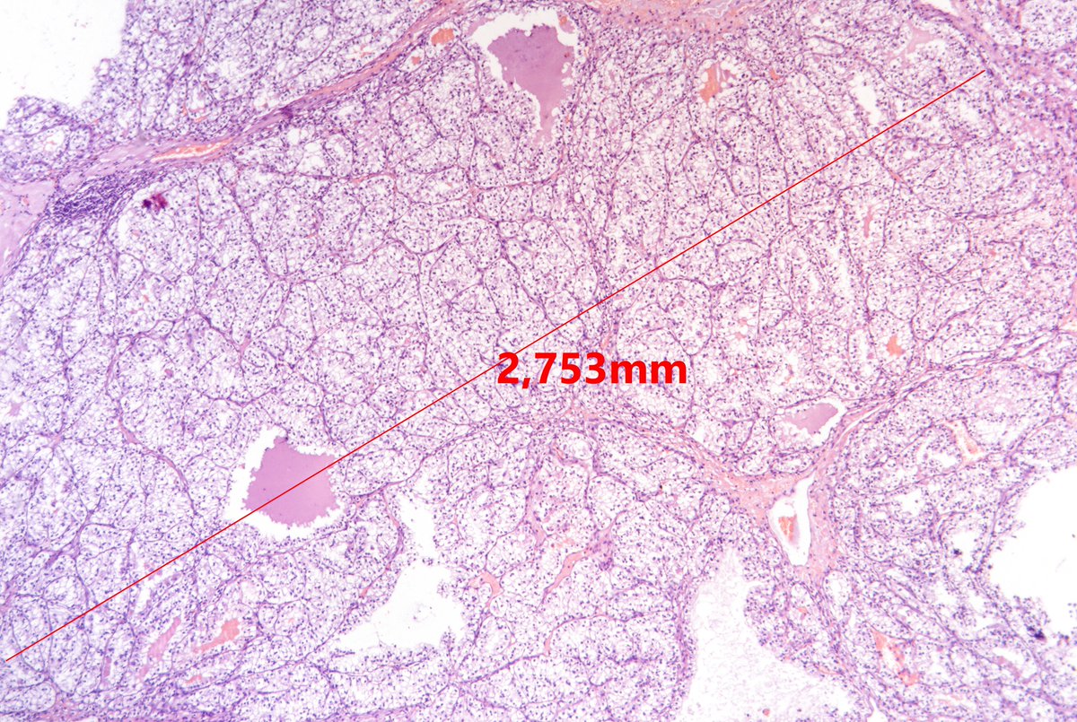 M,41,kidney resection. Clear cell renal cell carcinoma with extensive cystic change. #GUpath #grosspath #pathology #pathoutpic