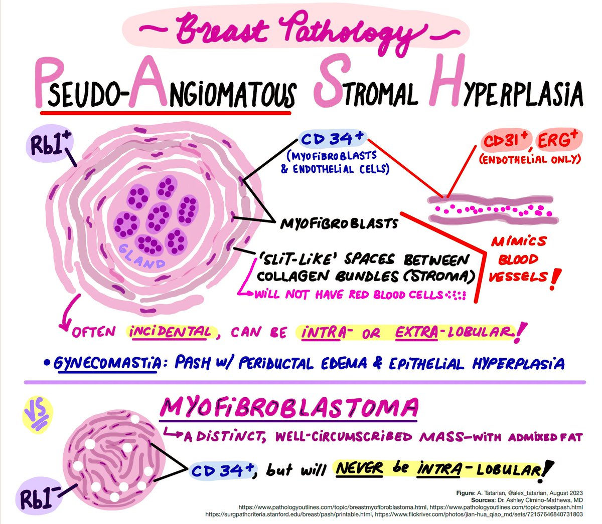 Check out this awesome pathology illustration about PASH and myofibroblastoma by medical student <a href="/alex_tatarian/">Alex Tatarian, MD</a> based on her experience rotating at Hopkins with breast pathologist Dr. Ashley Cimino-Mathews.