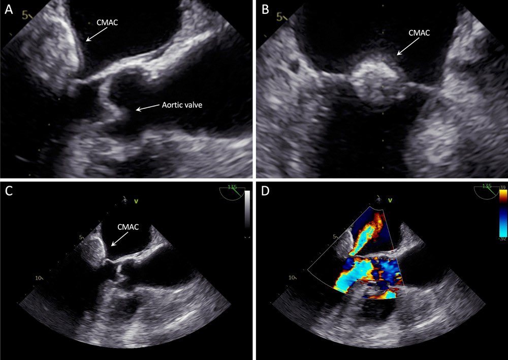 bara_doc's tweet image. Okay, the final presentation at #ESCcongress for today…

#CMAC pts, despite a benign prognosis, have increased non-AF related thromboembolism risks, including #stroke and #STEMI. Thus, always consider #echofirst as promoted by @NMerke 🫀⚡@escardio 

➡️ bit.ly/3PblmtZ