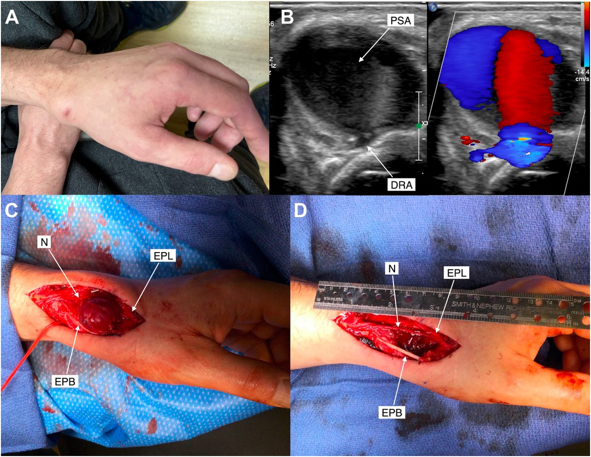 📑Distal radial artery pseudoaneurysm after #PCI treated w surgical repair #radialfirst #ldtra ➡️ doi.org/10.1016/j.jsca… @ekgpdx @brant_ullery @DanWesterdahl