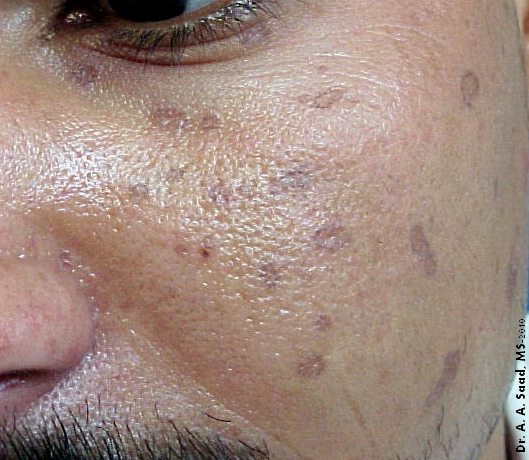 dermatology's tweet photo. Diagnosis? https://t.co/ipiMamBMkn