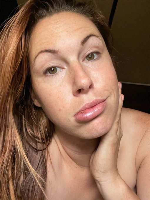 My lip formed a scab. But it&rsquo;s even more swollen this morning. Look like I got popped in a fight, all