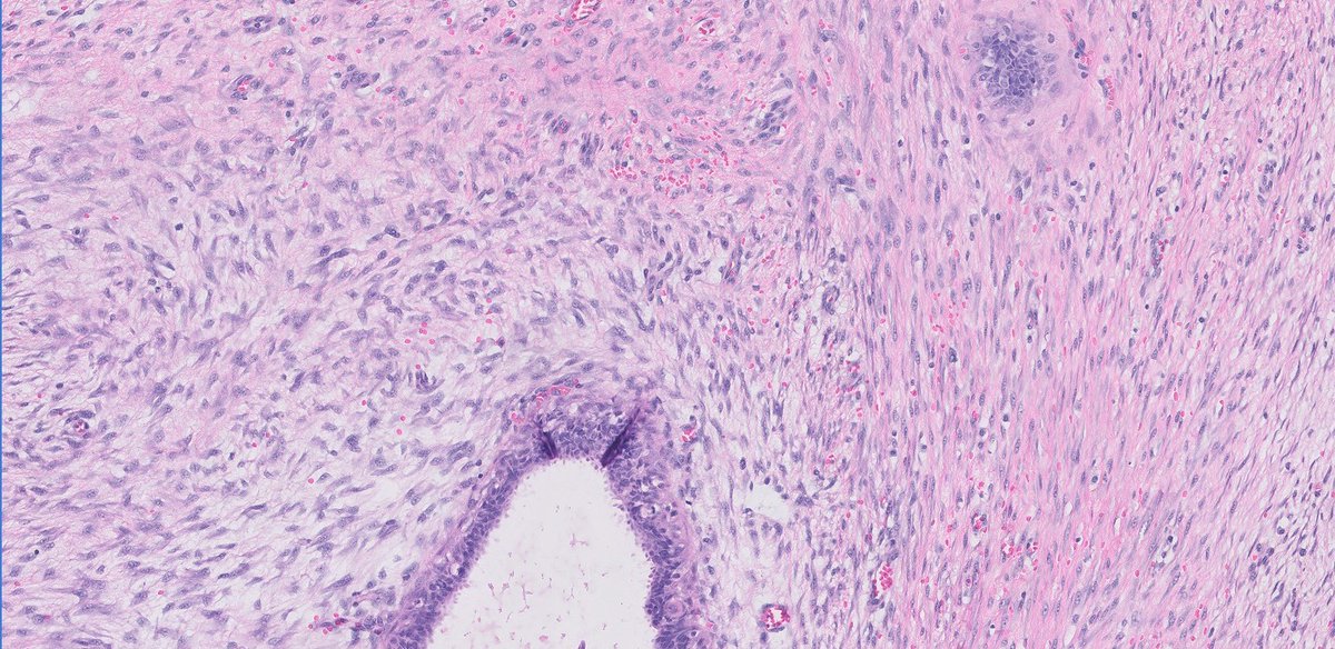 Thank you all for the replies. This is indeed a neurofibroma of the breast, the first one I have ever seen. No history of neurofibromatosis.

Benign spindle cell lesions of the breast can be quite challenging to diagnose because of significant morphologic overlap. However, the