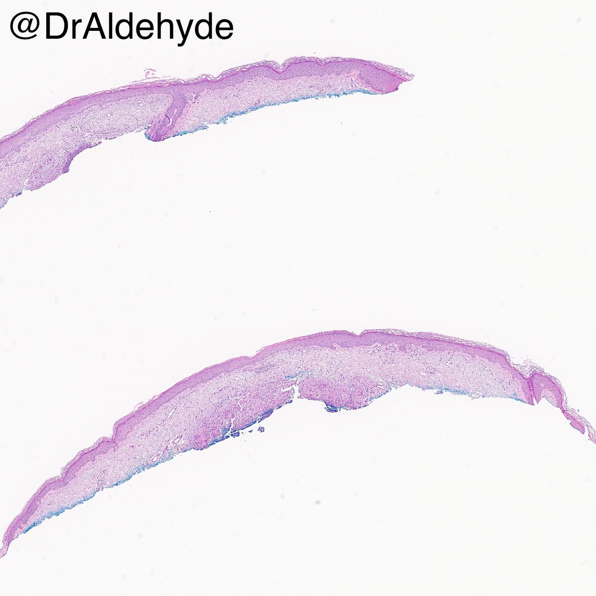 DrAldehyde's tweet image. Friday #dermpath special. 😆🔬

Too obvious on low power? Negatron! Go higher not to miss this diagnosis. 

Chromoblastomycosis

#pathology #IDpath 🍄🐛