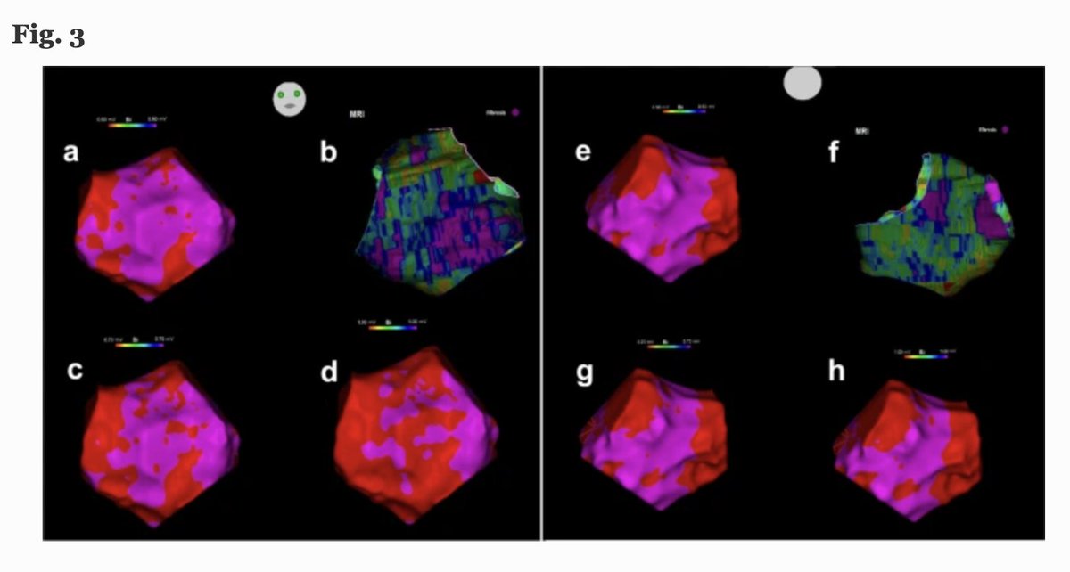 🚨New #FreeRead Article in
<a href="/JICE_EP/">JICE</a>

Optimizing Fibrosis Detection: Comparison of Electroanatomical Mapping &amp; Late Enhancement Gadolinium MRI

by PM Bansmann, <a href="/Ymohsen_MD/">Yazan Mohsen</a>, M Horlitz &amp; F Stöckigt

📖🧐 rdcu.be/dkpuS

#EPeeps