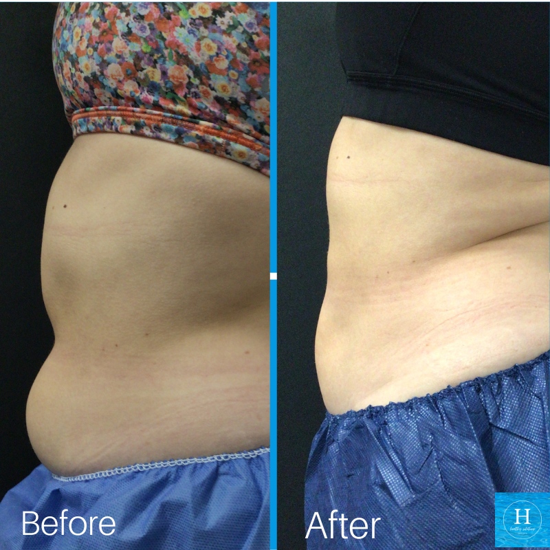 HlthySolMedSpa's tweet image. It's Freeze the Fat Away Friday!⁠
⁠
Reduce 20-25% of fat from the abdomen, love handles, thighs, arms, bra fat, back fat, double chin and more...⁠
⁠
Our patients love CoolSculpting, and you will too! ⁠
⁠
Book your appointment in our bio or:⁠
📅book.mypatientnow.com/practice/aV54zx