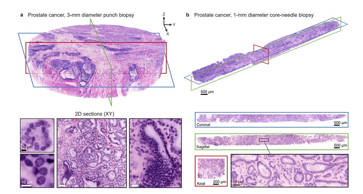3D #pathology  is coming our way. This will have a deep impact in the #cancer field. 3D pathology could enhance disease understanding, accuracy of diagnosis &amp; will unlock a world that interrogates orders-of-magnitude more tissue &amp; provides a feature-rich volumetric context for