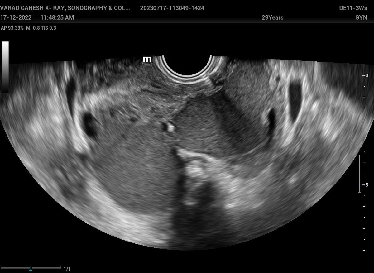 ScholarMDIndia's tweet photo. #Endometrioma #OvarianEndometrioma #SlidingSign Bilateral Ovarian endometrioma stuck to each other as well as Posterior Surface of Uterus. Need DIE detail scan https://t.co/DwnQz1yXaC