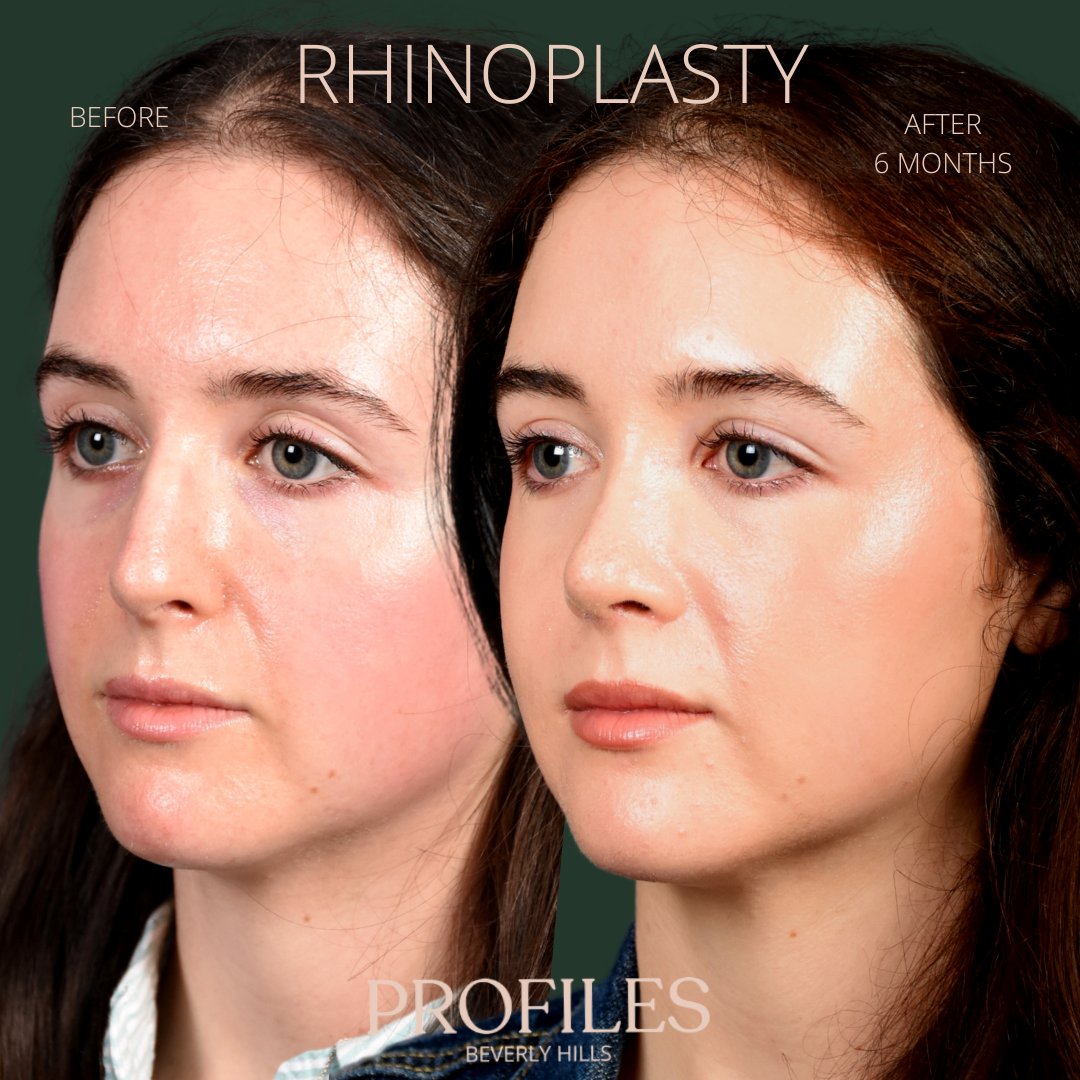 FacialPlastics's tweet photo. 📞310-276-6800
🏠 435 N Bedford Drive, PH500, Beverly Hills, 90210
👃Rhinoplasty
🗓 Before and After 6 Months
🛏 About 1 week, the cast gets taken off after 6 days

Swipe ⏩⏩⏩ for more views

Call or DM us to schedule your consultation

We also offer virtual co... https://t.co/H9MFparluR