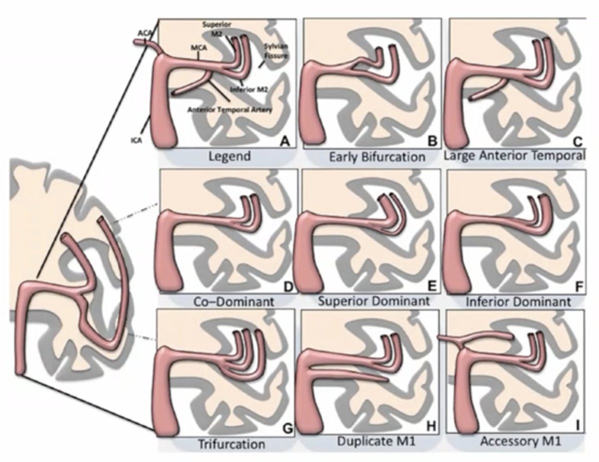 MCA anatomical Variants:
#VascularNeurology
#INR
#InterventionalNeurology
#neurotwitter 
#Neuroradiology