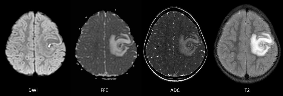 4♂. Seizures. How reliable is this uncommon finding of DWI restriction as seen here of ?scolex ? In this part of the world we very often burn our fingers in differentiating NCC & TB on MR. #NeuroX #neurotwitter #MedX #MedTwitter #radtwitter #RadX #FOAMmed #FOAMrad #NCC