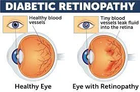 diabetes_clin's tweet photo. Submit your article on #Diabetic #eye #disease: It occurs when #retina get #damage due to #Diabetes. In which it leads to #blurred vision, #fluctuating vision, #impaired color vision, etc.
Journal: https://t.co/KDIJgNRc9E
submission link: https://t.co/7hNigTUHI7 https://t.co/URRX2gkGHT