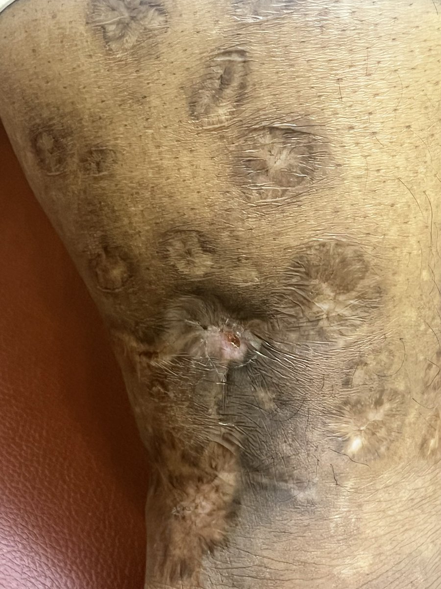 PRAVINBANODKAR's tweet photo. #Pyoderma #Gangrenosum 
Large Deep Painful Ulcers over Legs 
Heal with deep Scars 
Prevention Immunotherapy 
How would you treat the new lesions ? #Dermatology #Residents please lend your #tweets Views !
#Medtwitter #Dermtwitter https://t.co/UfD1sb17Kp